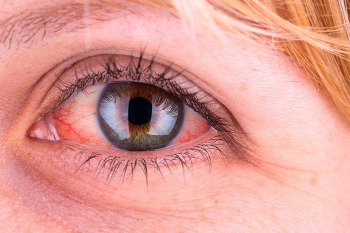 Identify Fatty Liver Symptoms Through the Eyes, Be Alert in Time hummernews.in
